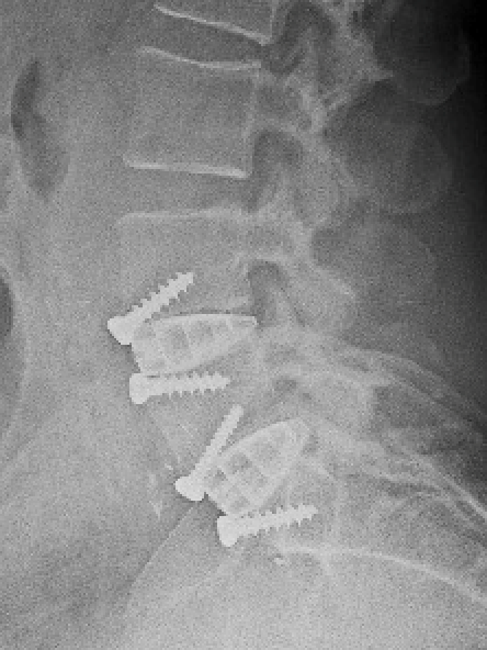 Arthrodèse lombaire par voie postérieure ALIF 2