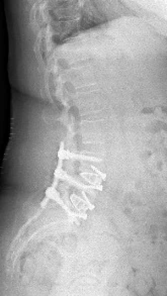 Arthrodèse thoraco-lombaire par voie postérieure 1